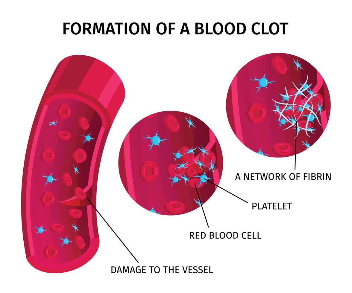 infographie de thrombus de cellules sanguines vecteur
