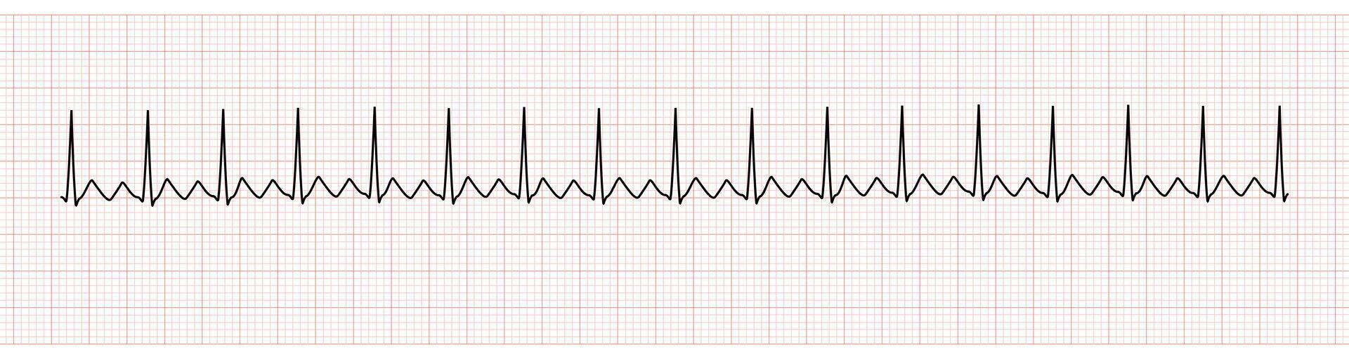 ekg moniteur montrant un procès battement avec 2 à 1 un V bloquer vecteur