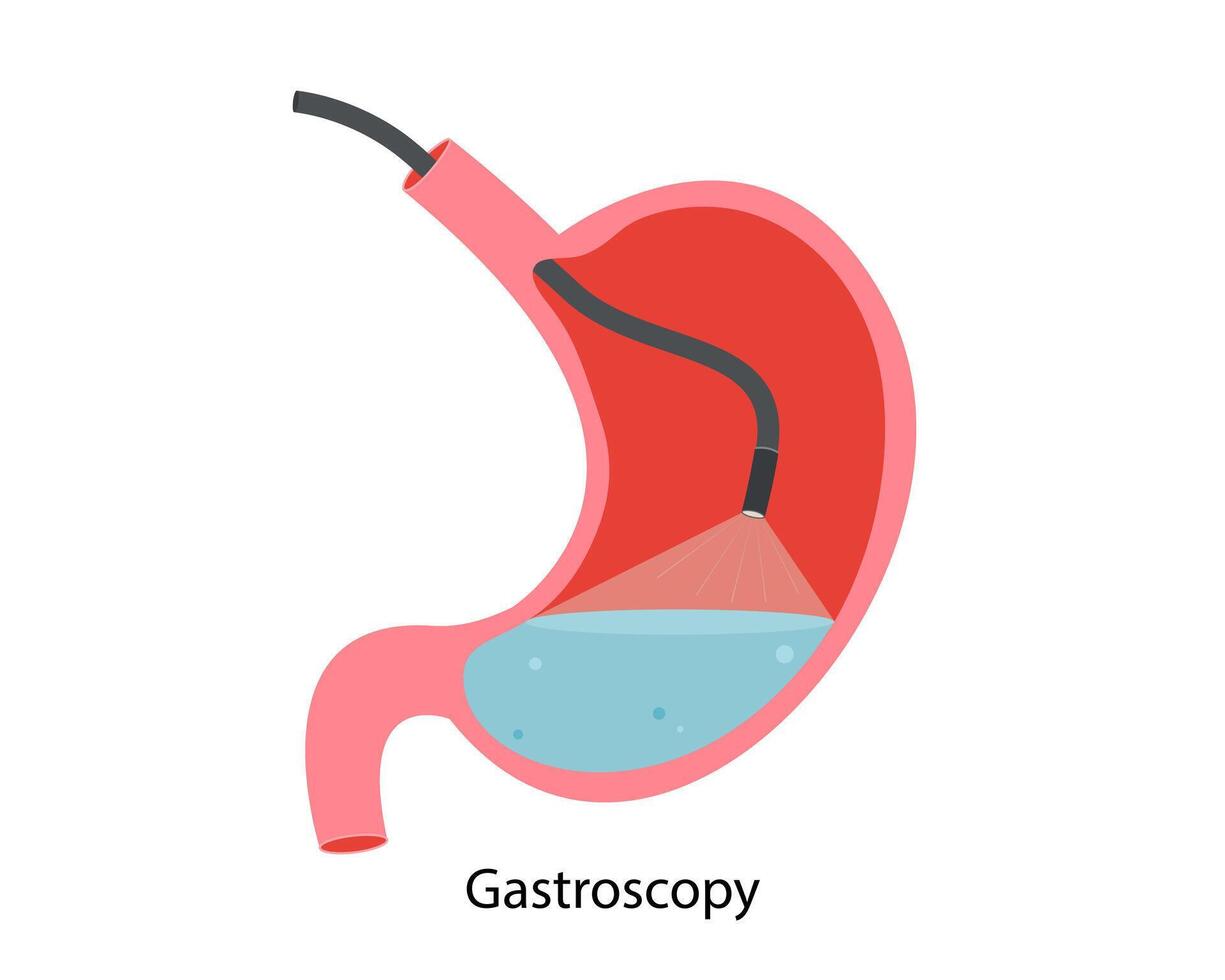 gastroscopie procédure. recherche de une estomac gastroscope. maladie de le estomac et duodénum. fermer vecteur image de le estomac