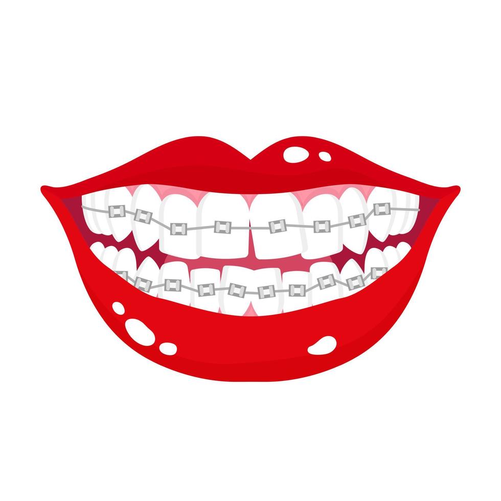 bouche souriante de dessin vectoriel avec étapes d'alignement des dents tordues à l'aide d'appareils orthodontiques métalliques.