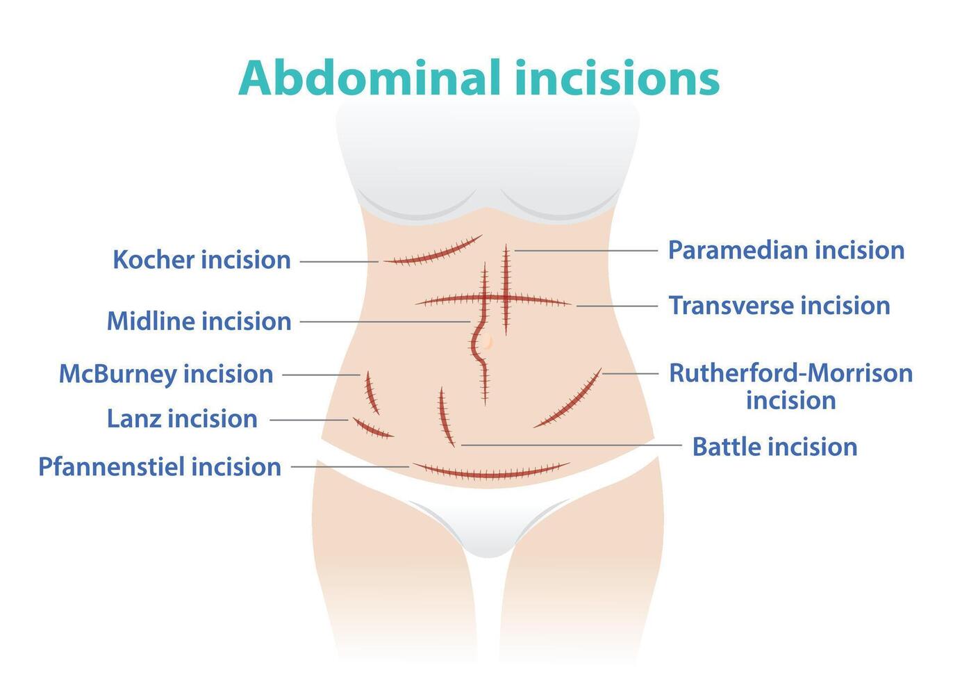 les types de abdominal incision pour chirurgie vecteur illustration isolé sur blanc Contexte. kocher, ligne médiane, McBurney, lance, pfannenstiel, paramédian, transversal, Rutherford Morrison, bataille incision.