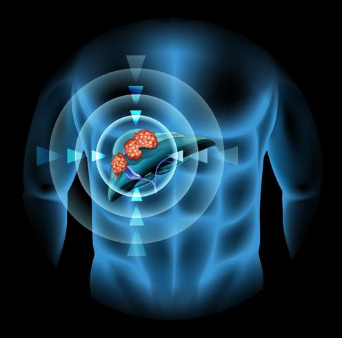 Diagramme du cancer du foie montrant les détails vecteur