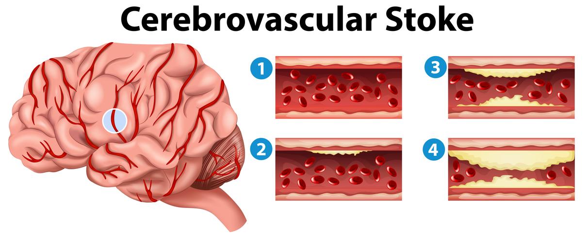 Diagramme montrant les stades de l&#39;accident vasculaire cérébral vecteur