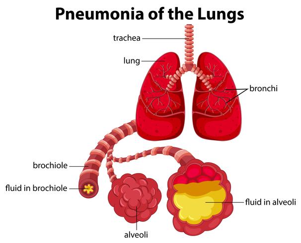 Schéma de la pneumonie des poumons vecteur