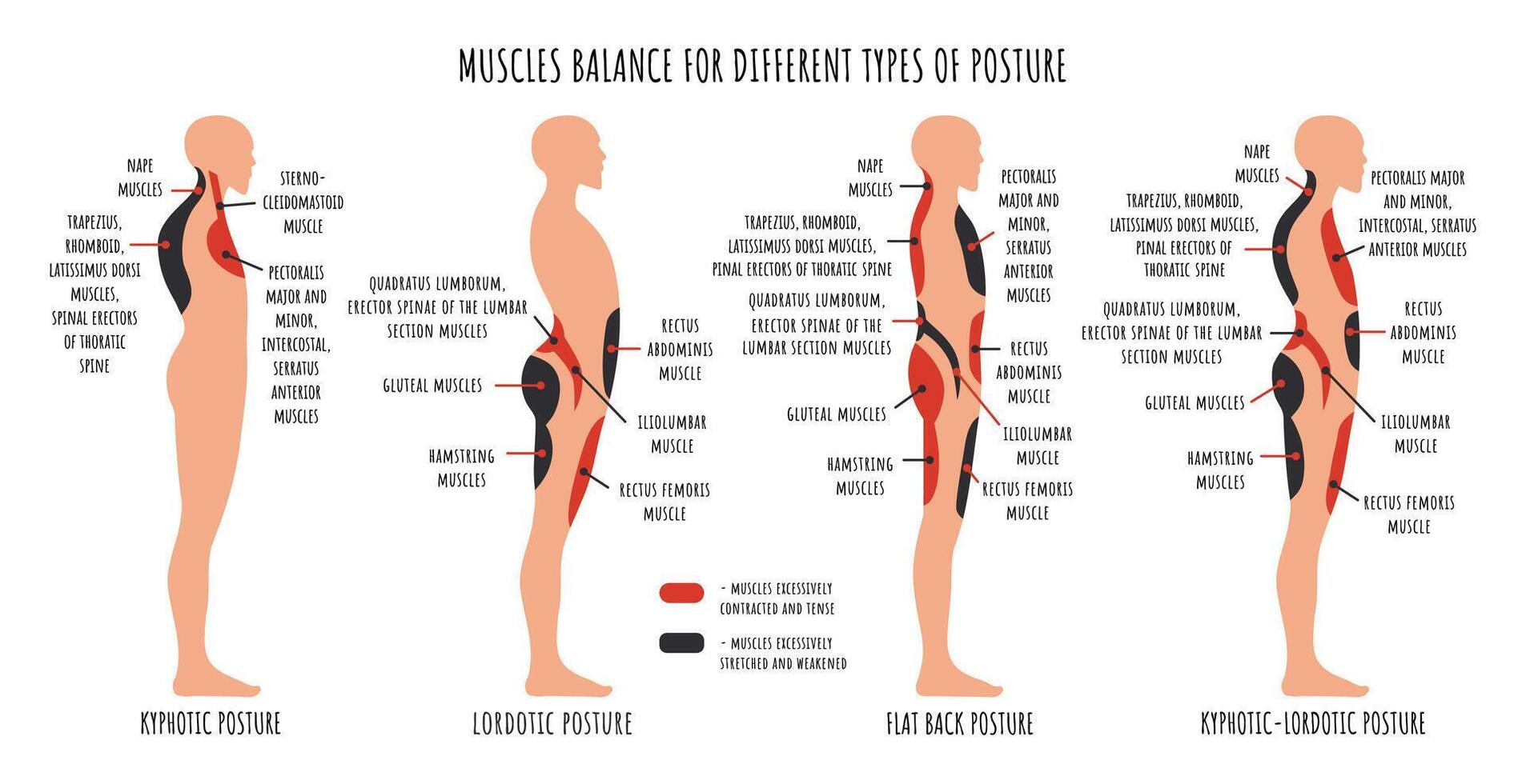 Comparaison de muscle déséquilibre dans divers posturale troubles. cyphotique, lordotique, plat retour posture infographies. vecteur