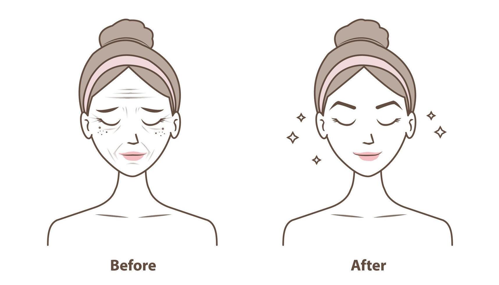 avant et après les rides sur femme visage illustration isolé sur blanc Contexte. Comparaison de vieillissement, endommagé et beauté peau dans dessin animé style. peau se soucier et beauté concept. vecteur