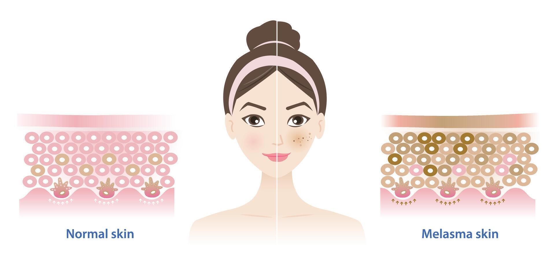 Comparaison de Ordinaire et mélasma peau sur femme visage illustration sur blanc Contexte. diagramme de en bonne santé épiderme peau couche, mélasma et foncé taches. peau se soucier et beauté concept. vecteur