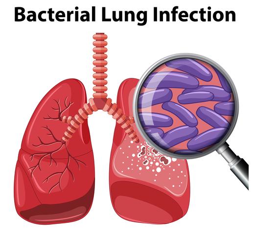Une infection pulmonaire bactérienne sur fond blanc vecteur