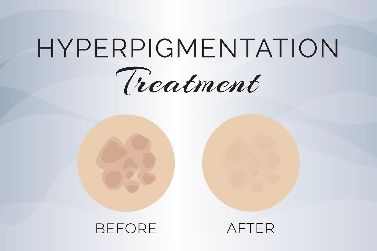 hyperpigmentation traitement avant et après illustration conception vecteur