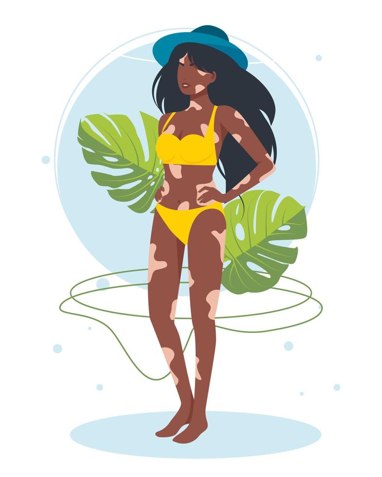 maladie de la peau vitiligo chez une fille afro-américaine en maillot de bain. femme avec un diagnostic de vitiligo bronzer sur la plage n'est pas timide. le concept de beauté différente, corporellement positif, acceptation de soi. vecteur