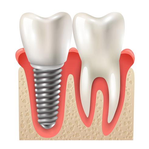 Modèle de plan rapproché de jeu de dents d&#39;implant dentaire vecteur