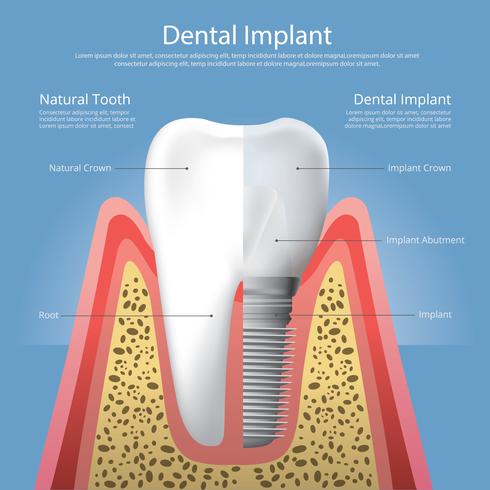 Illustration vectorielle de dents humaines et implant dentaire vecteur