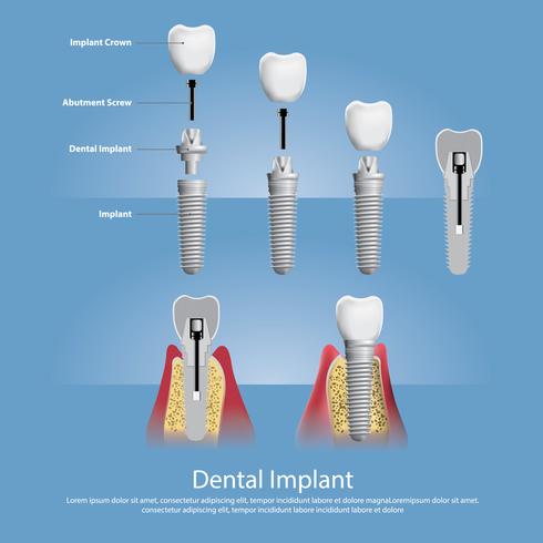 Illustration vectorielle de dents humaines et implant dentaire vecteur