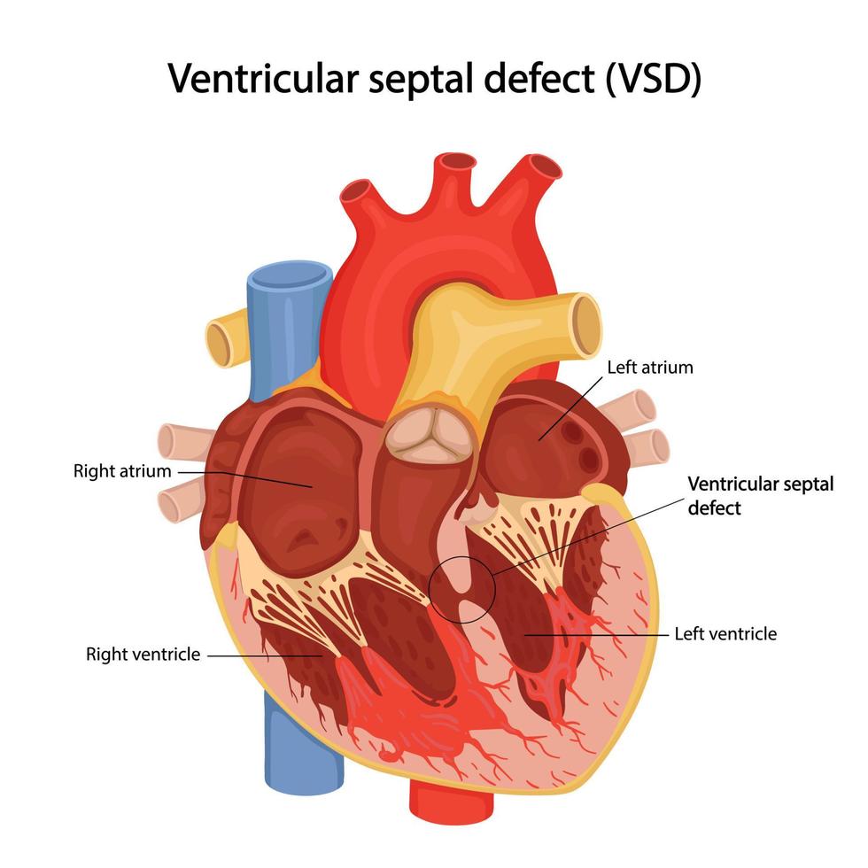 illustration anatomique de dessin animé de défaut septal ventriculaire vecteur
