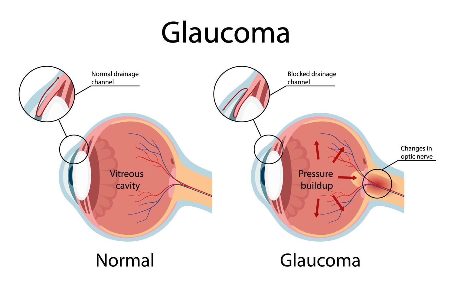 glaucome. illustration montrant un glaucome à angle ouvert. anatomie des yeux en style cartoon vecteur