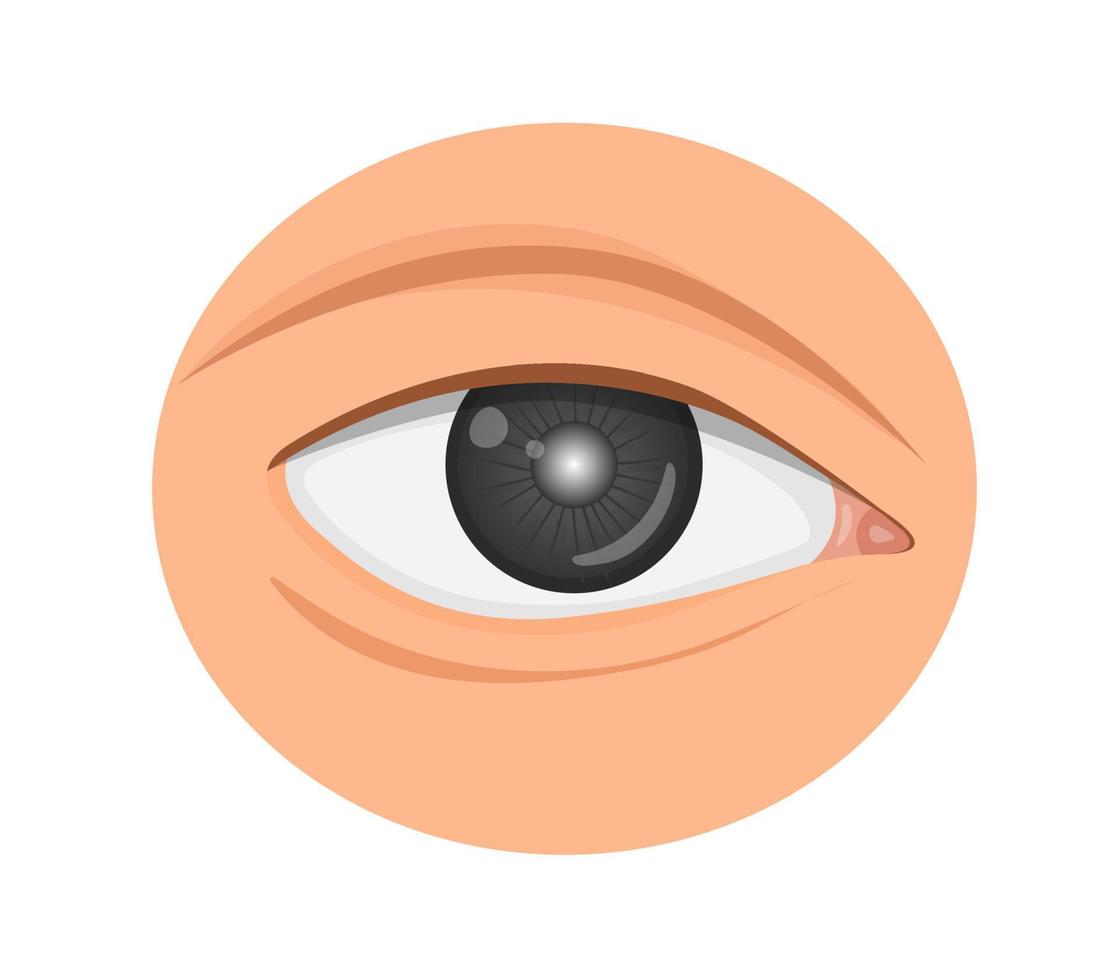 œil douloureux et cristallin obscurci par la cataracte. illustration sur la vision. vecteur