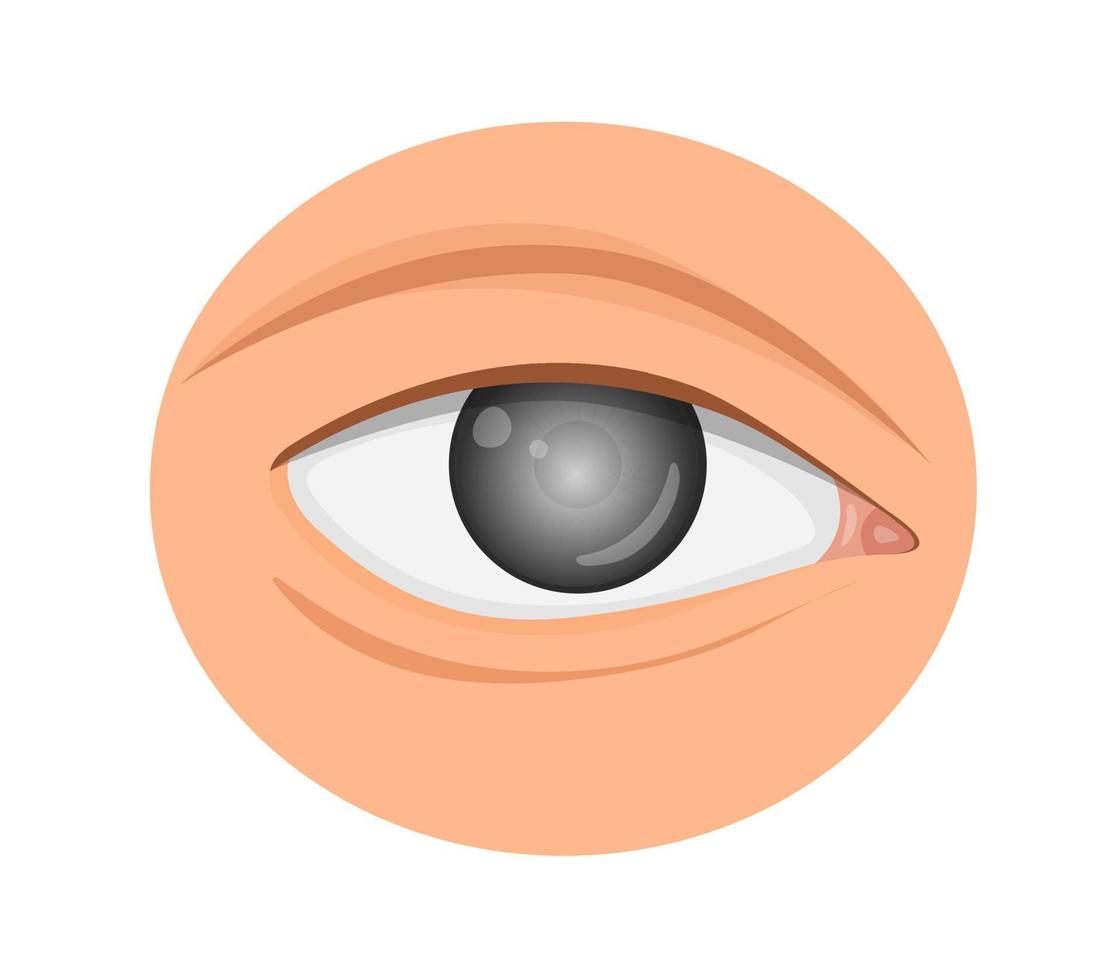 œil avec vue rapprochée du glaucome. turbidité, aqueux du globe oculaire. illustration vectorielle. vecteur