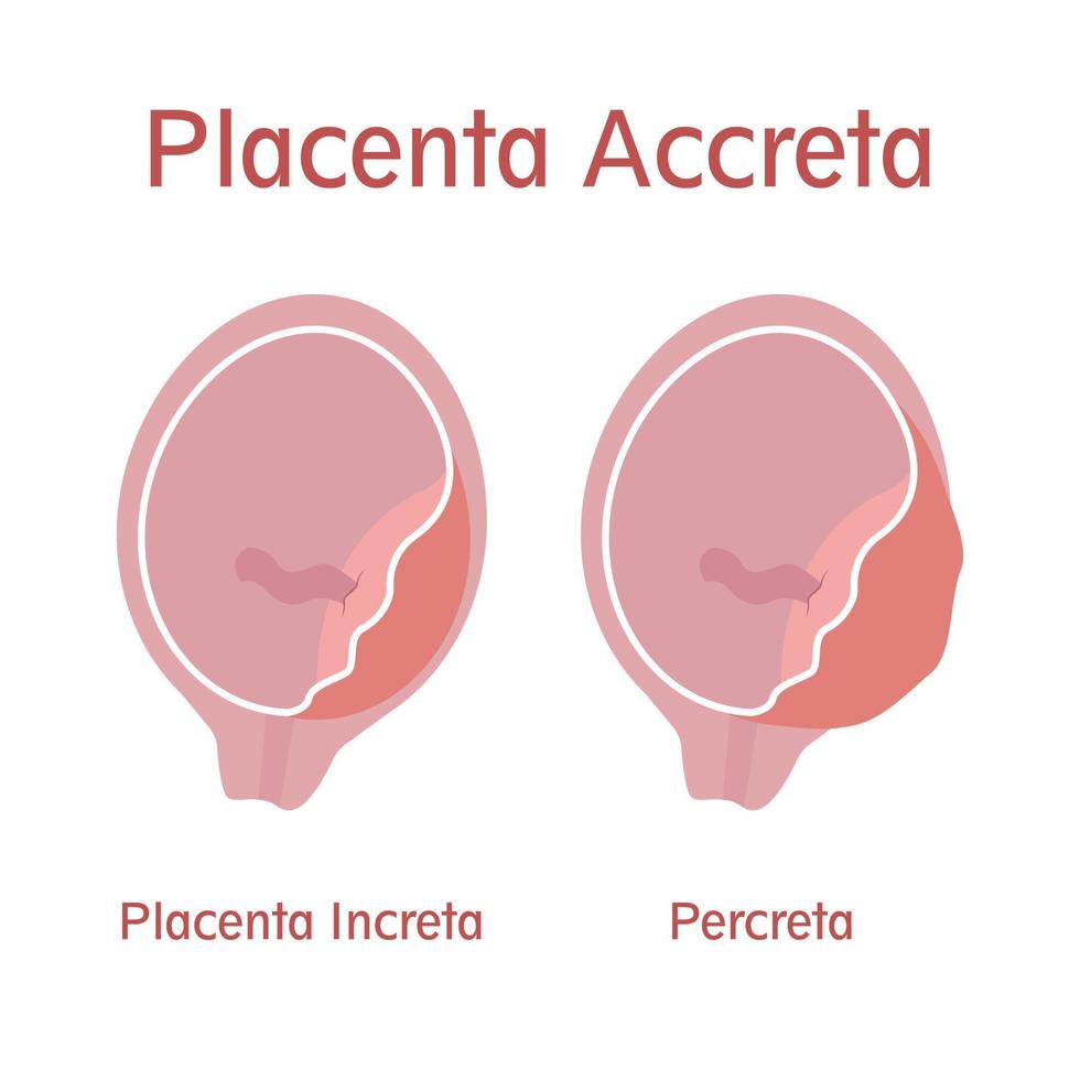 placenta increta et percreta vecteur