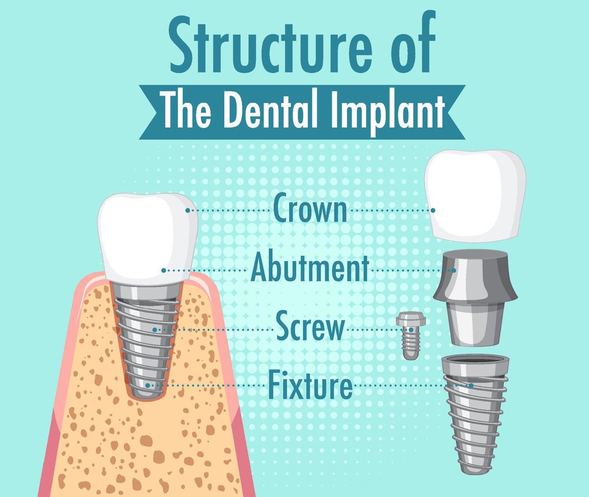 infographie de l'homme dans la structure de l'implant dentaire vecteur