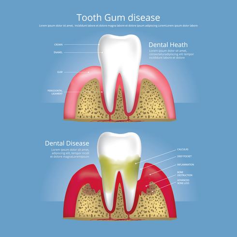 Dents humaines Étapes de l&#39;illustration vectorielle de la maladie des gencives vecteur