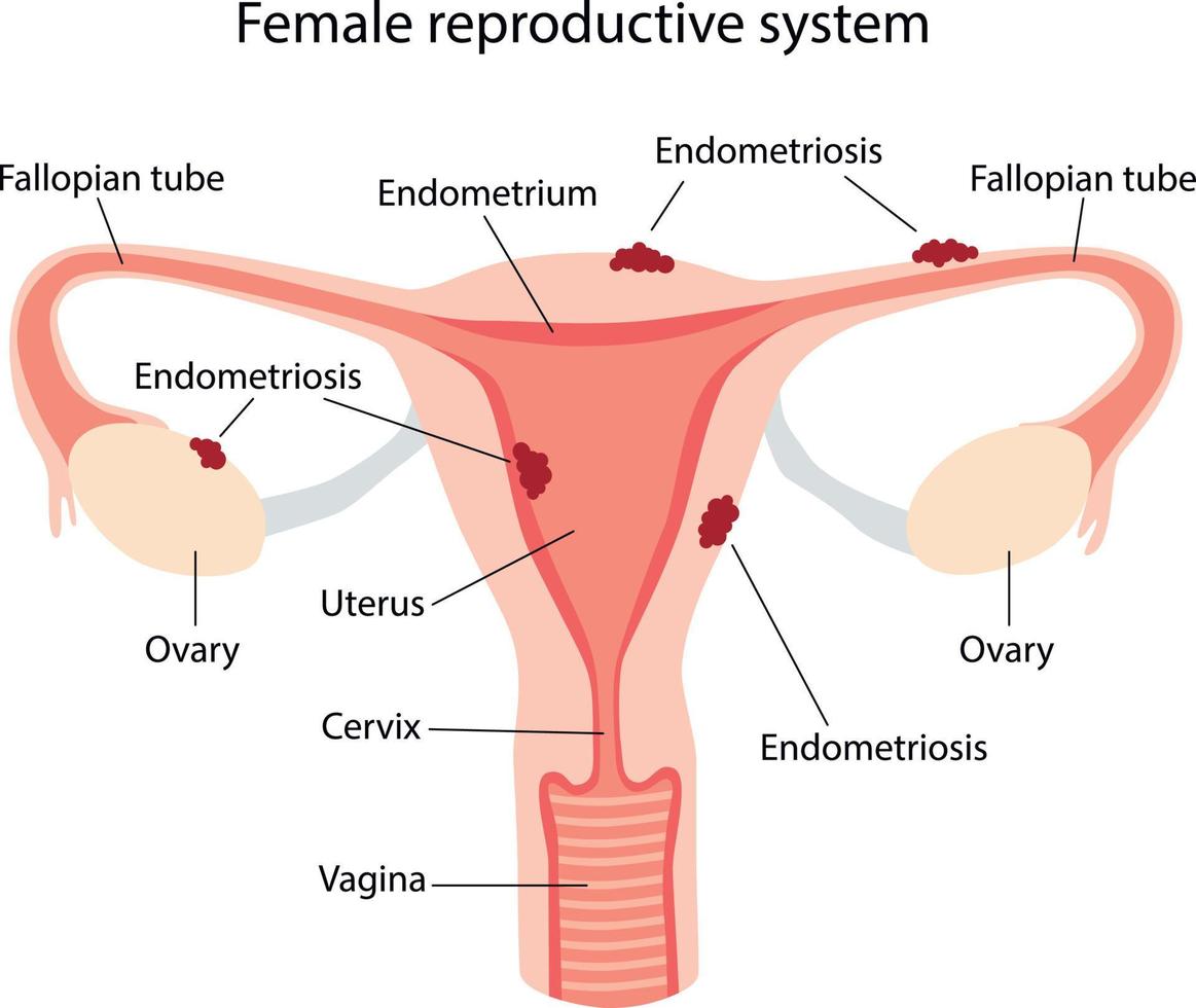 endométriose, illustration schématique des maladies de l'appareil reproducteur féminin vecteur
