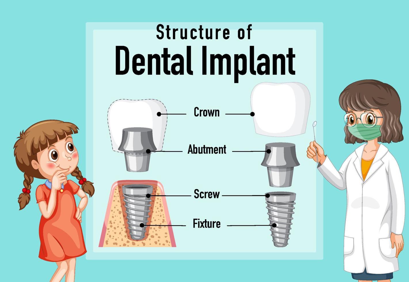 infographie de l'homme dans la structure de l'implant dentaire vecteur