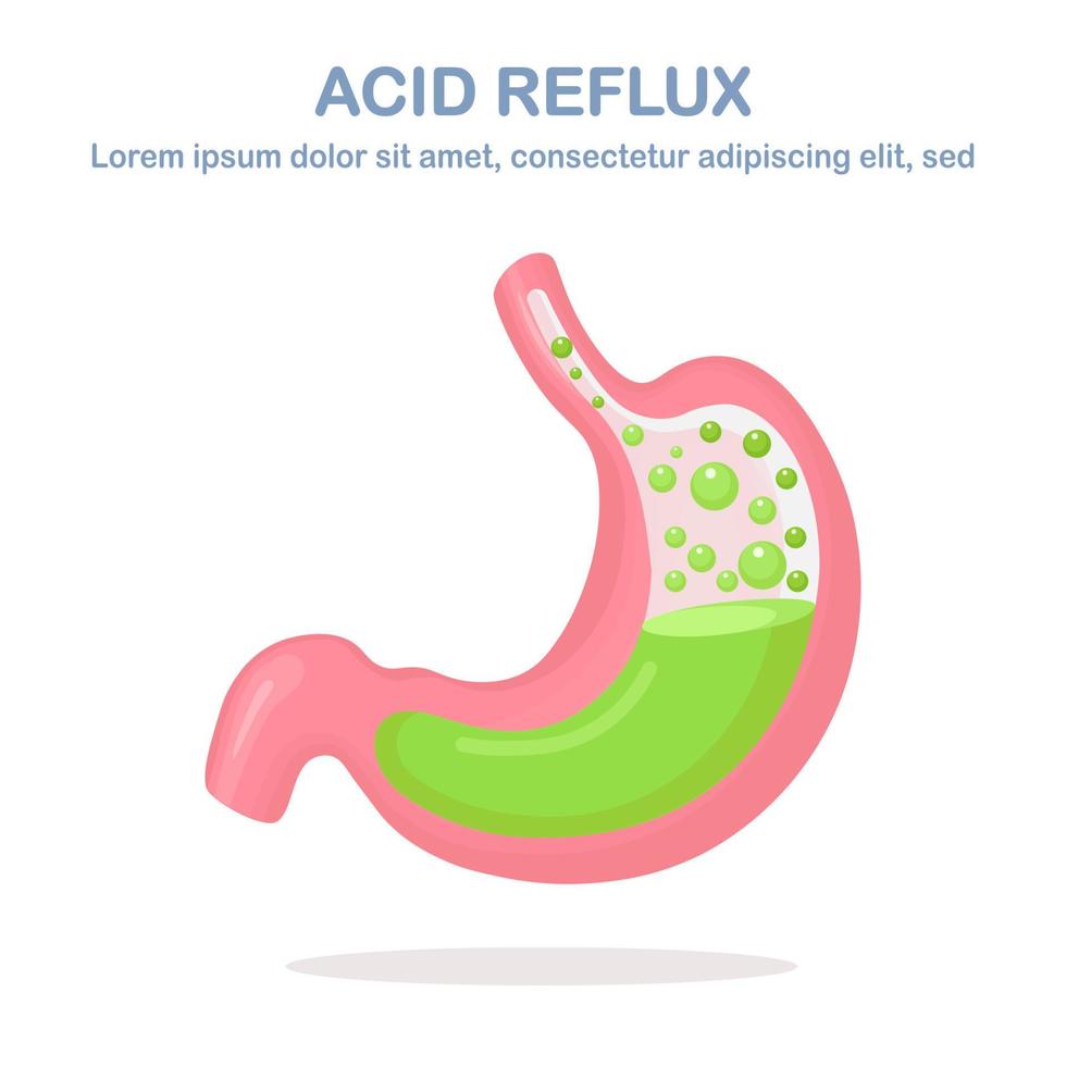 estomac humain. reflux gastro-œsophagien. RGO, brûlures d'estomac, infographie gastrique. l'acide remonte dans l'œsophage. conception plate de vecteur