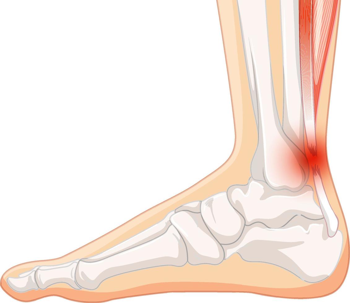 rupture du tendon d'achille sur fond blanc vecteur