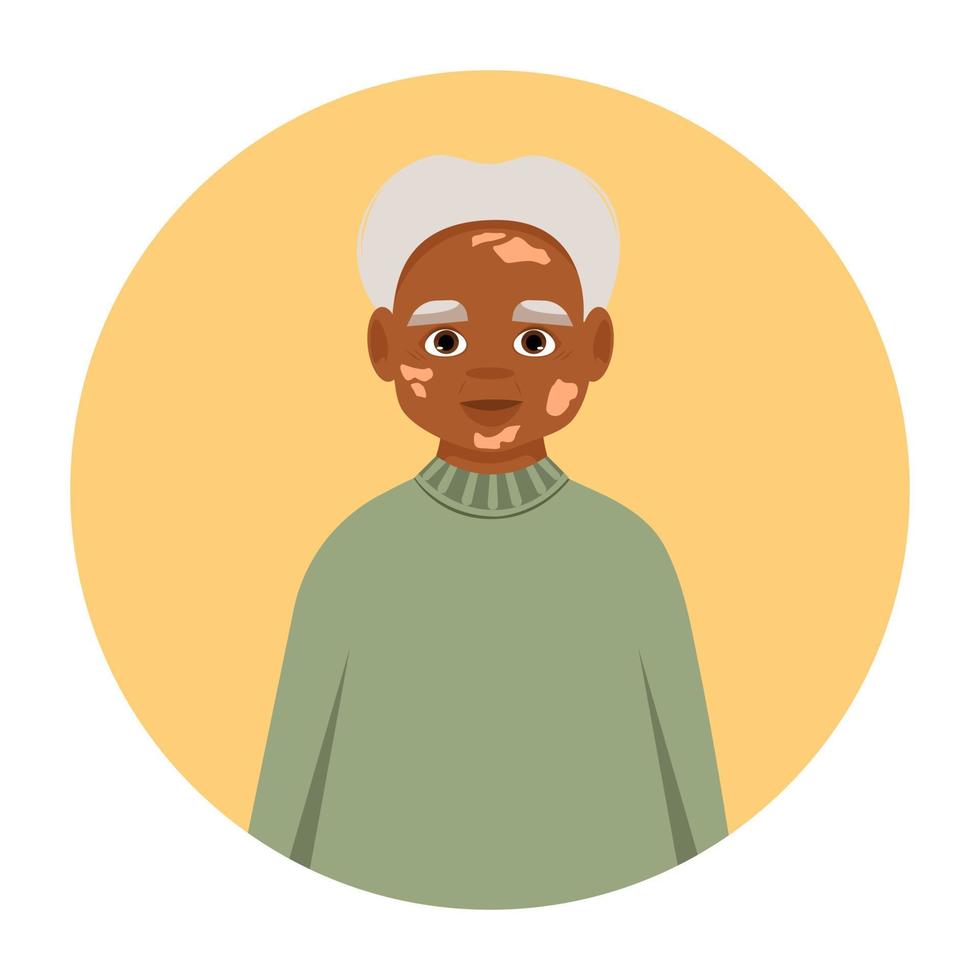 avatar de l'homme vitiligo. portrait d'humain dépigmenté. journée mondiale du vitiligo. vecteur