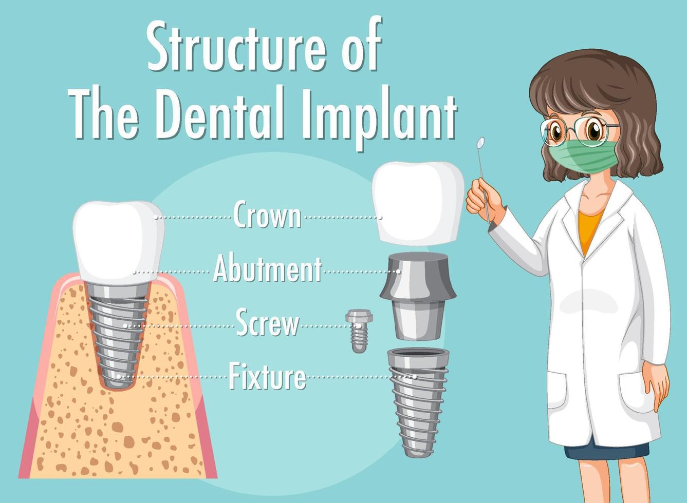 infographie de l'homme dans la structure de l'implant dentaire vecteur