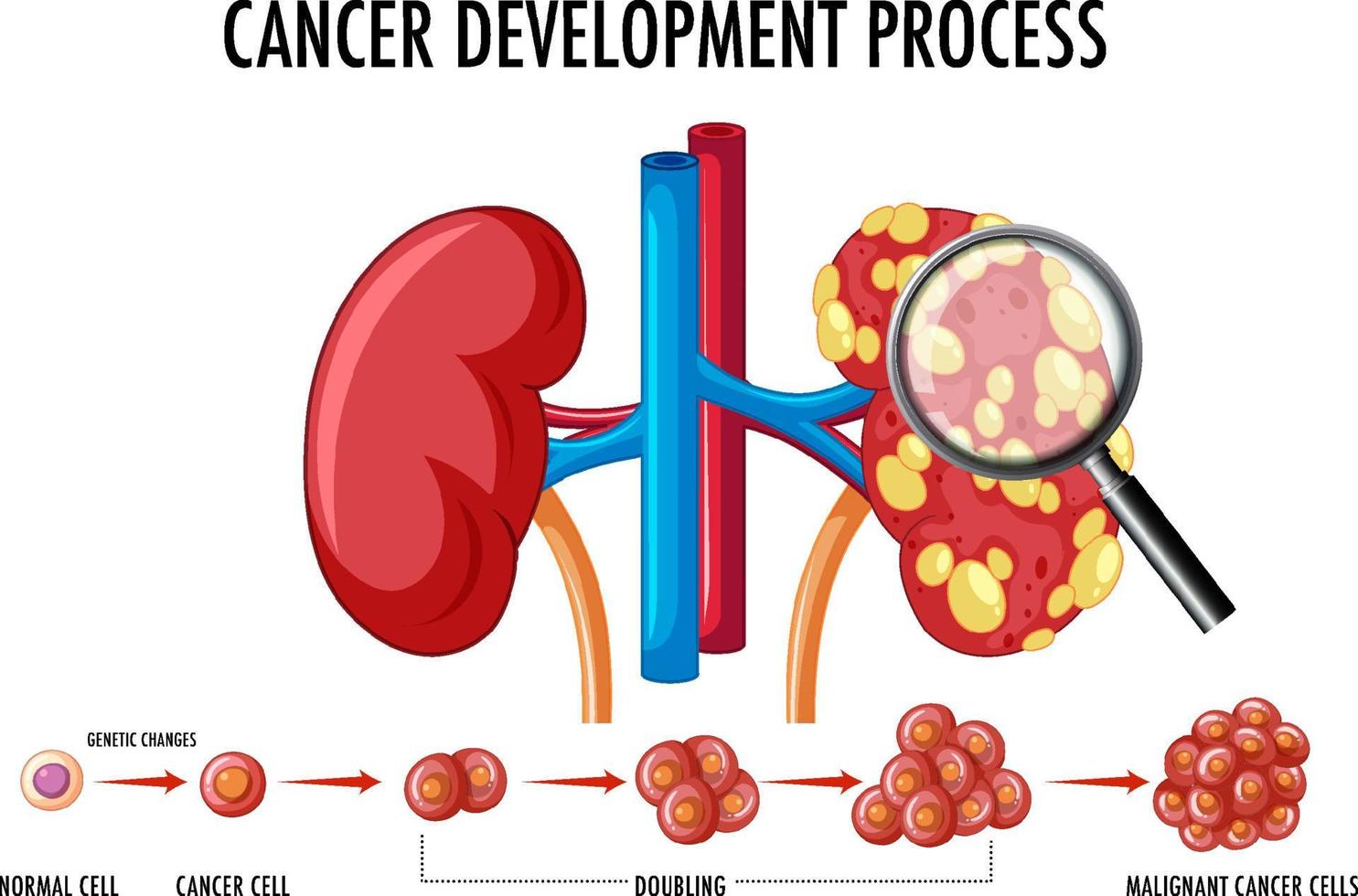 schéma montrant le processus de développement du cancer vecteur