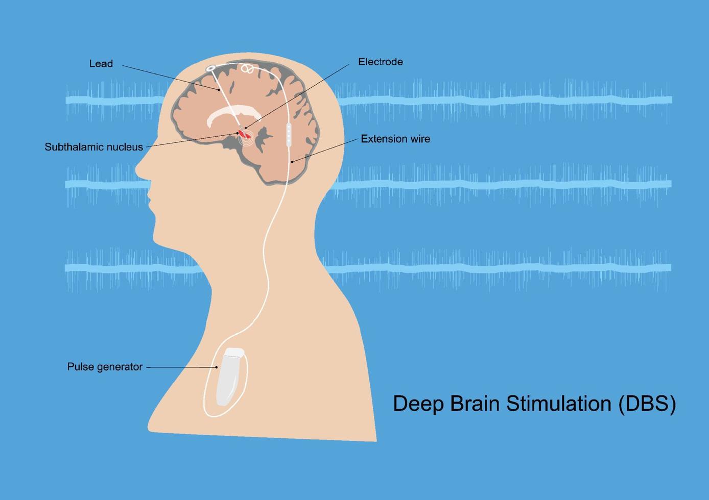 stimulation cérébrale profonde pour la maladie de parkinson vecteur