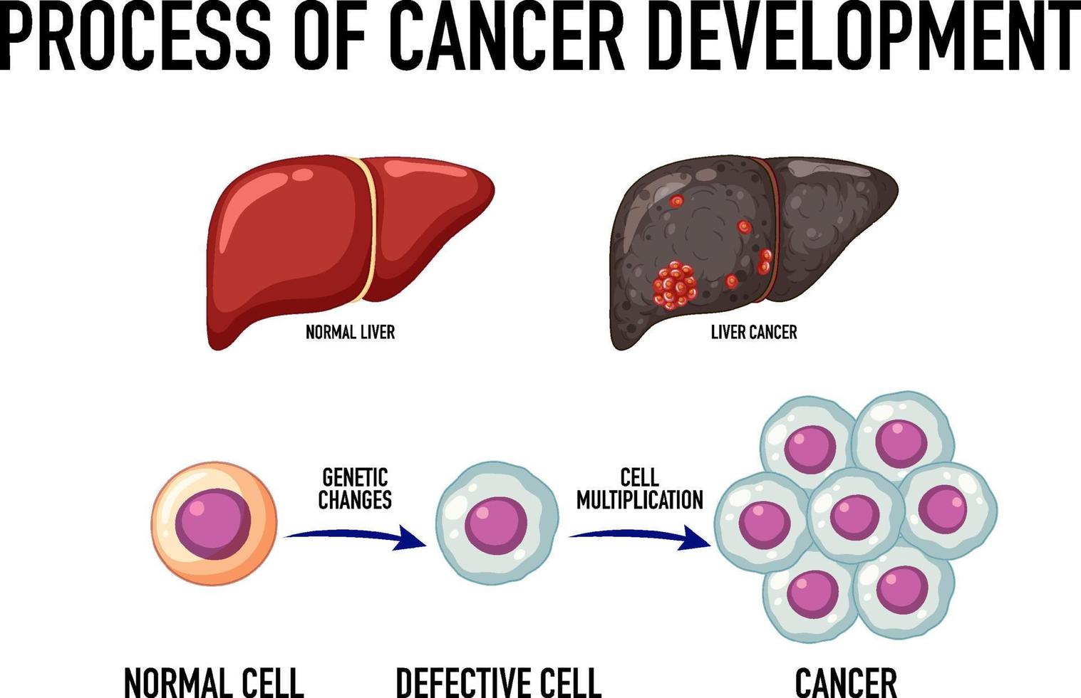 schéma montrant le processus de développement du cancer vecteur