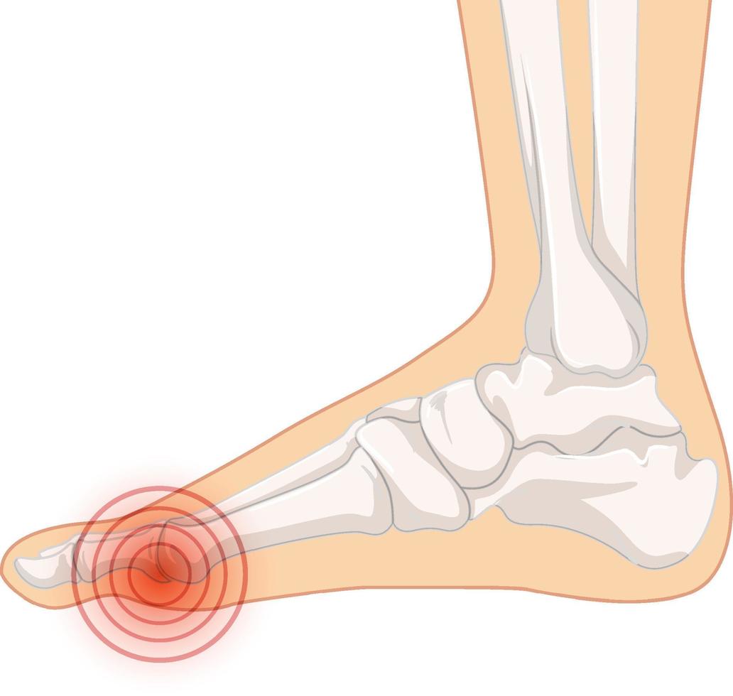 types d'hallux valgus sur fond blanc vecteur