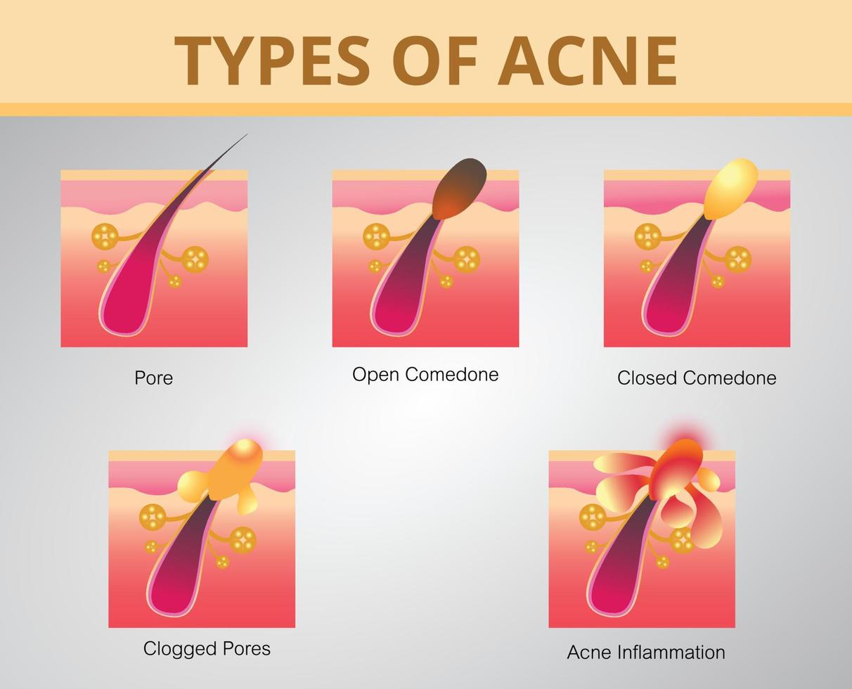 acné, stades de développement, peau saine, conception vectorielle vecteur