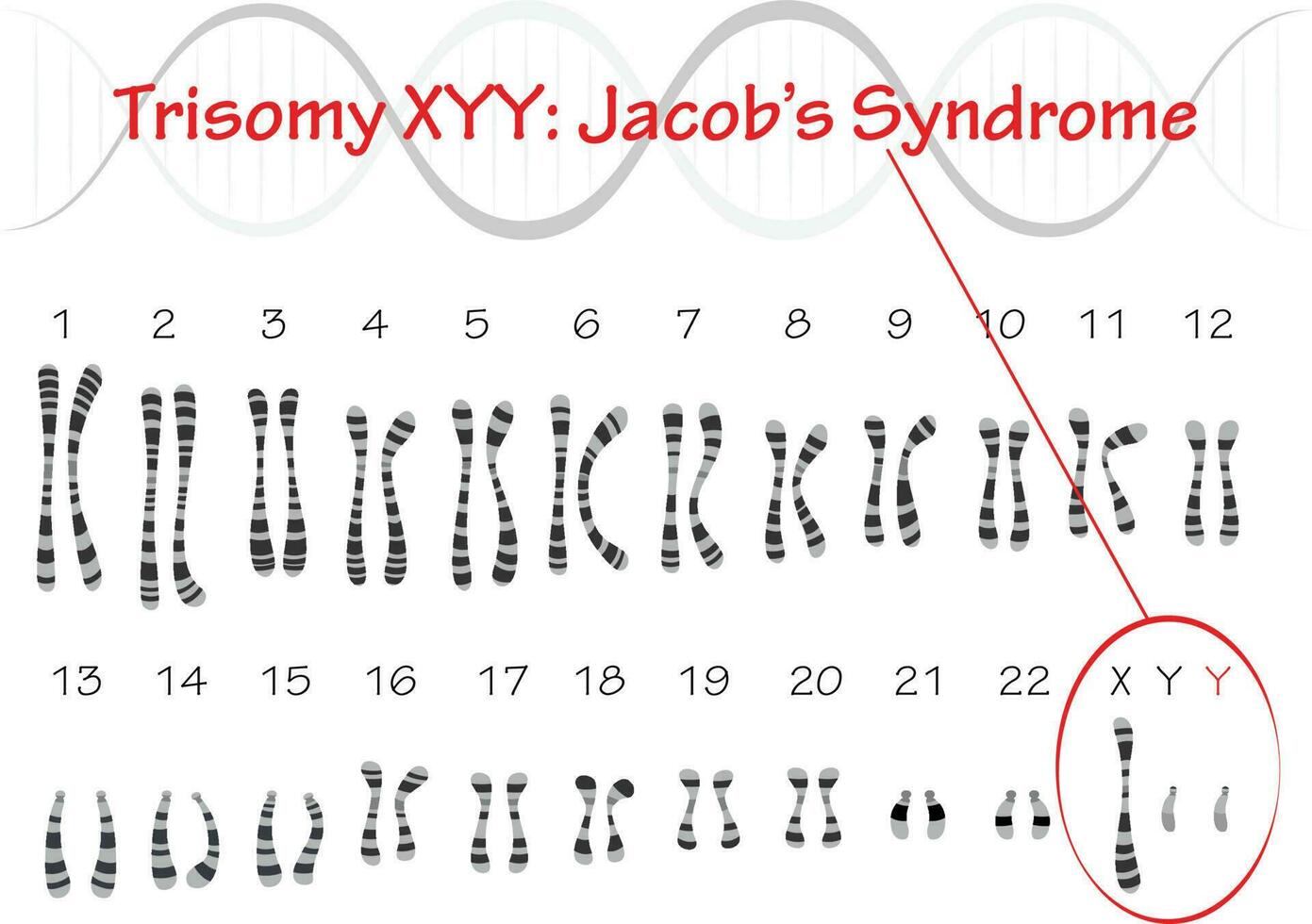 syndrome de trisomie xyy jacobs vecteur