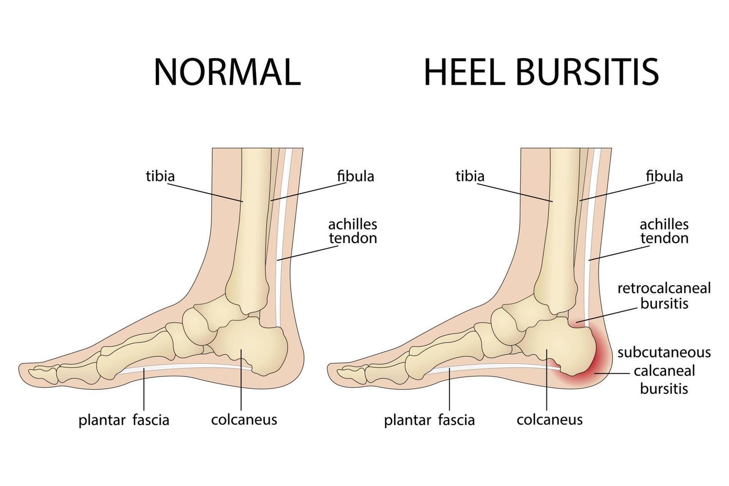 bursite calcanéenne. pied avec talon normal et pied avec déformation de Haglund et bursite. vecteur