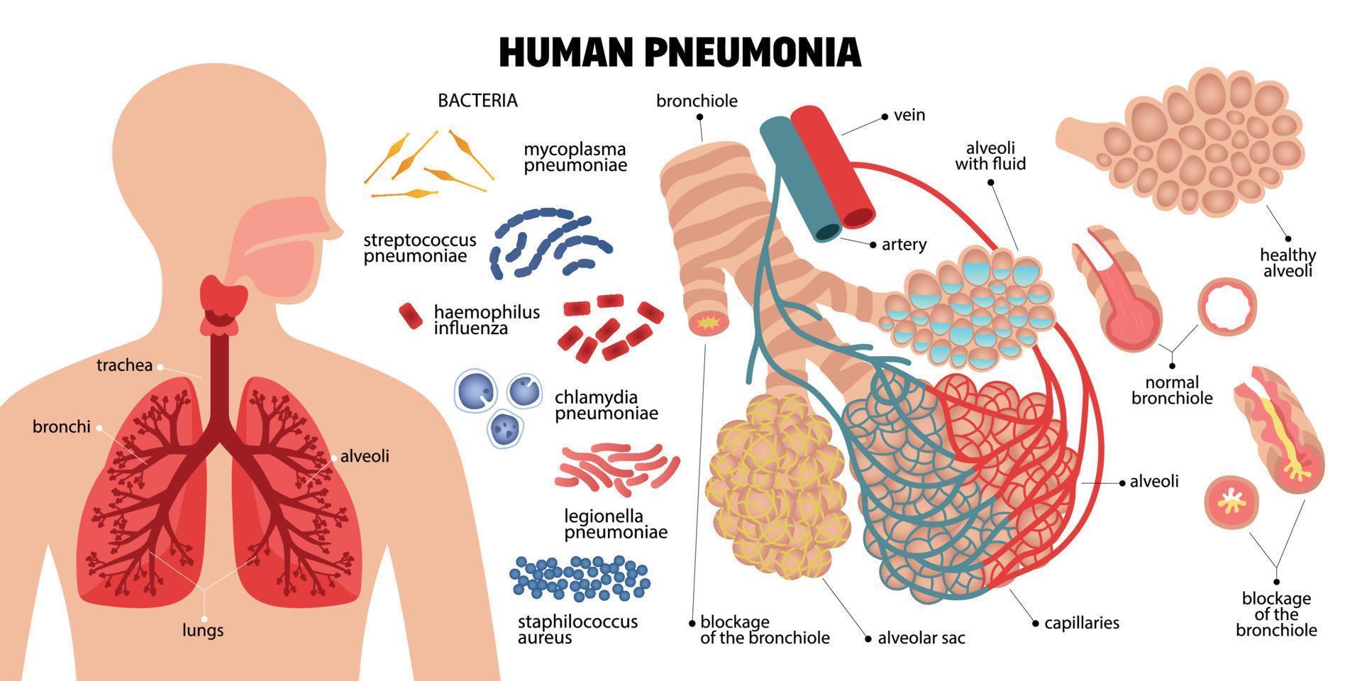 composition infographique de la pneumonie humaine vecteur