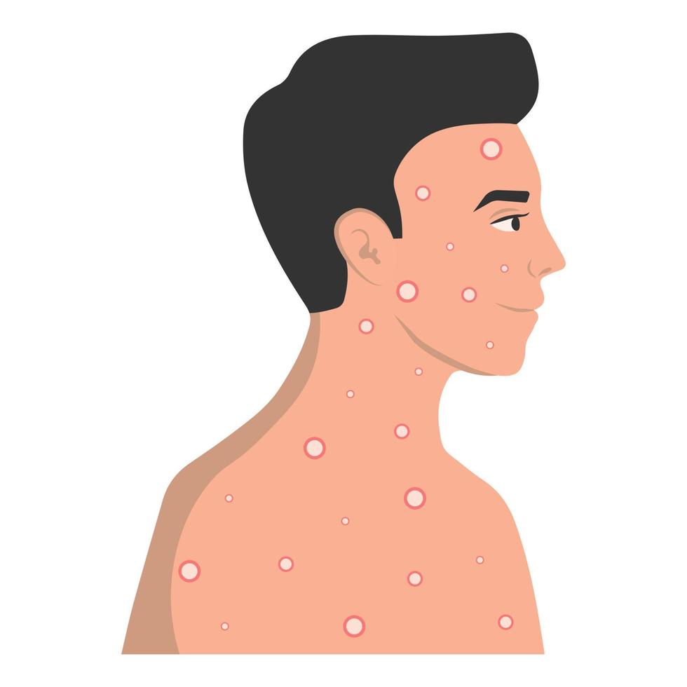 éruption cutanée sur le corps en tant que symptôme du virus de la variole, du virus de la variole du singe, de la grippe, du rhume. illustration vectorielle. vecteur