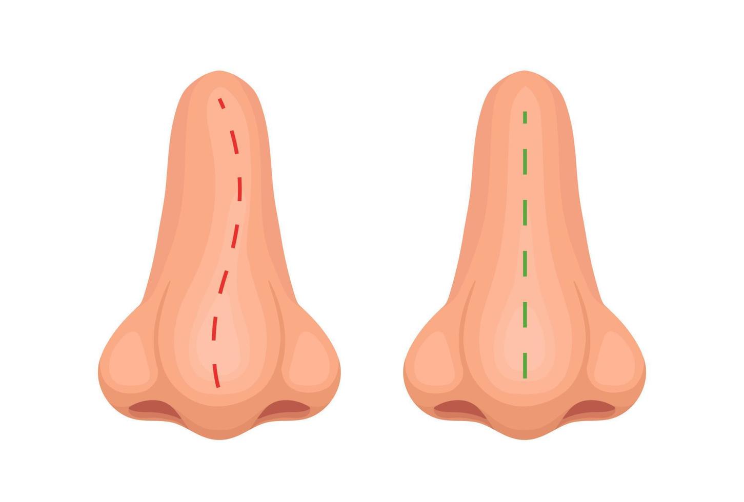 nez crochu et correct. nez avant et après le traitement. illustration vectorielle vecteur