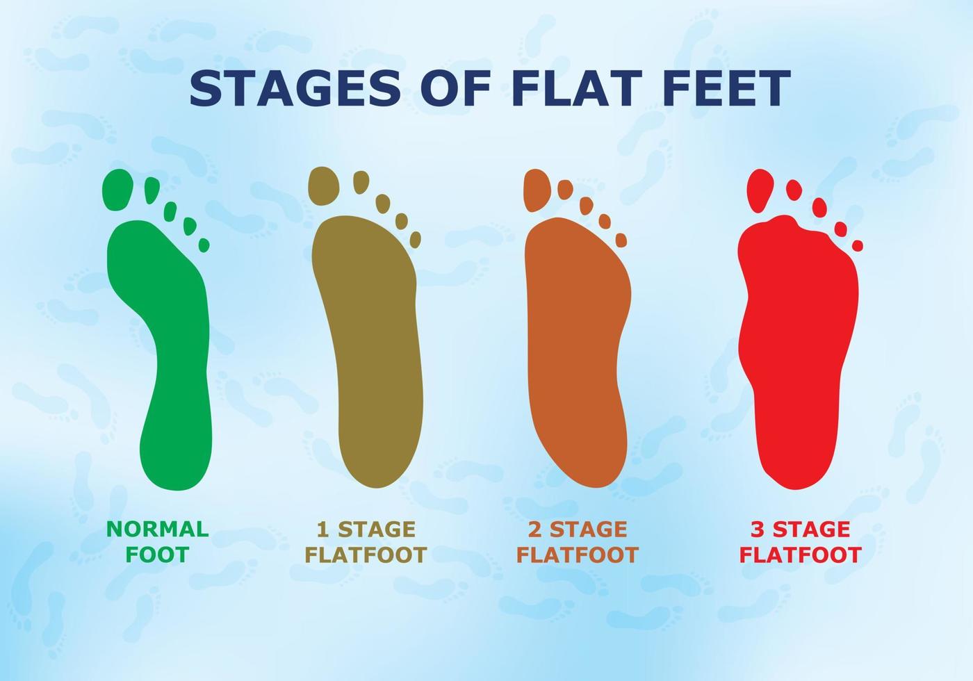 affiche éducative sur les pieds plats, les différents stades de la maladie. vecteur