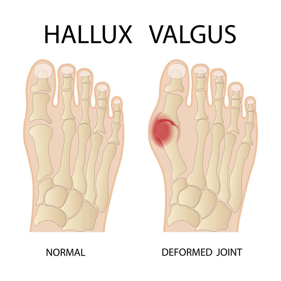 infographie médicale de l'hallux valgus. illustration vectorielle. vecteur