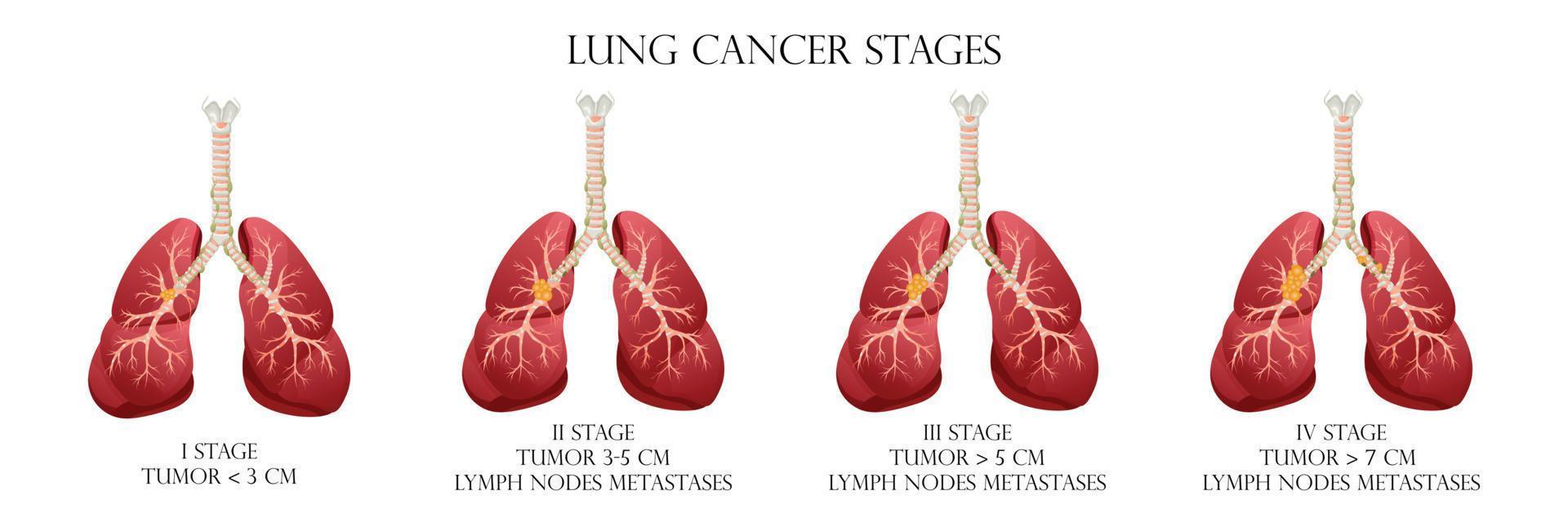 stades du cancer du poumon. concept maladies organes internes humains. style de dessin animé, illustration vectorielle. vecteur