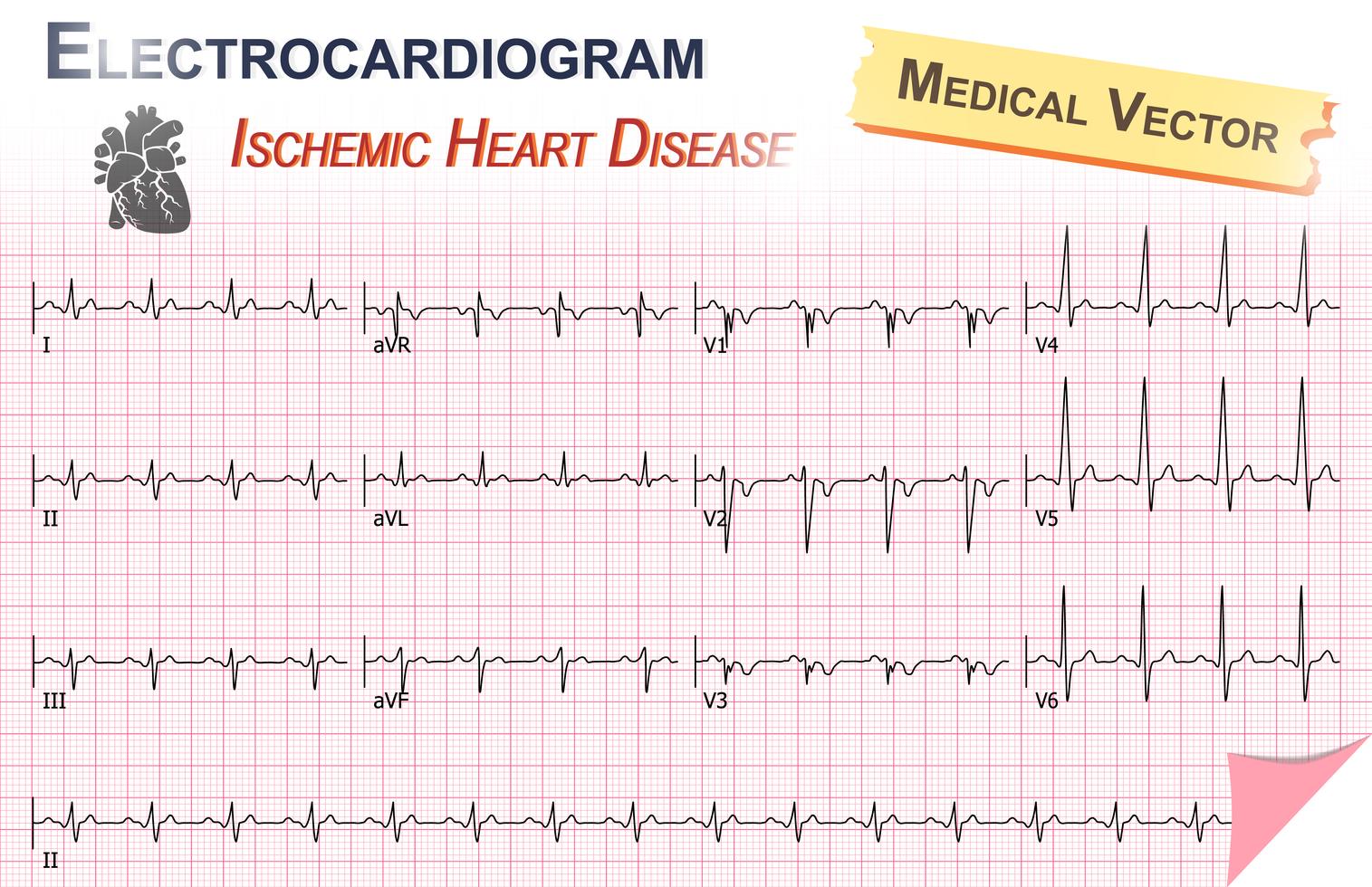 Électrocardiogramme (ECG, ECG) de la cardiopathie ischémique (infarctus du myocarde) et anatomie du cœur vecteur