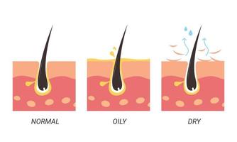 illustration des pores normaux, gras et secs vecteur