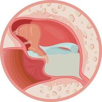 infection de l'oreille avec illustration vectorielle de fluides vecteur