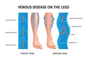 affiche infographique sur la maladie veineuse des jambes vecteur