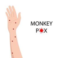 symptôme de monkeypox sur la main humaine. variole du singe vecteur