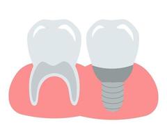 une dent saine, propre et solide et un implant installé dans une gencive rose. illustration dentaire vectorielle pour la conception et la décoration. vecteur