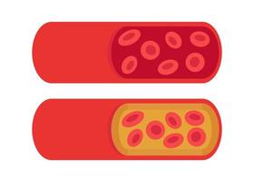 artère normale et bloquée par le cholestérol. caillot sanguin, thrombus, plaque d'athérosclérose. thrombose veineuse profonde dvt ou caillot artériel, flux vasculaire sanguin. circulation bloquée dans les vaisseaux sanguins. vecteur